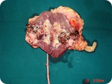 kidney tumor 2